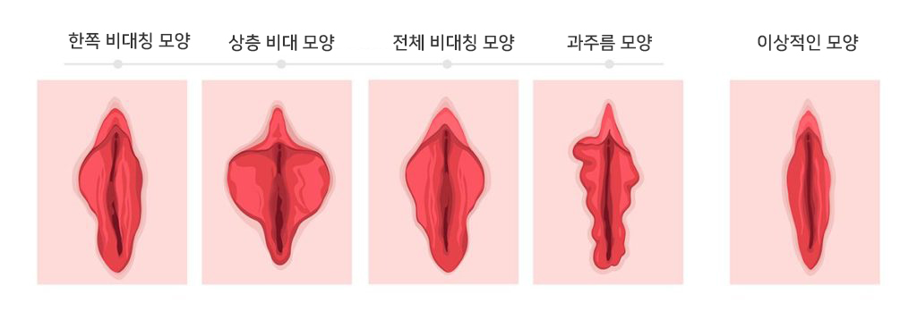 소음순 변형 모양