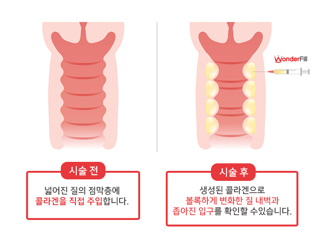 질필러 시술 이미지